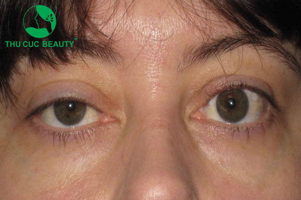 Dấu hiệu cắt mí bị trợn