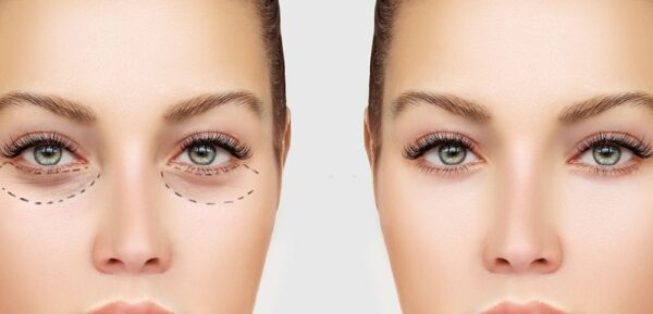 Cấy mỡ hốc mắt và những điều cần biết.