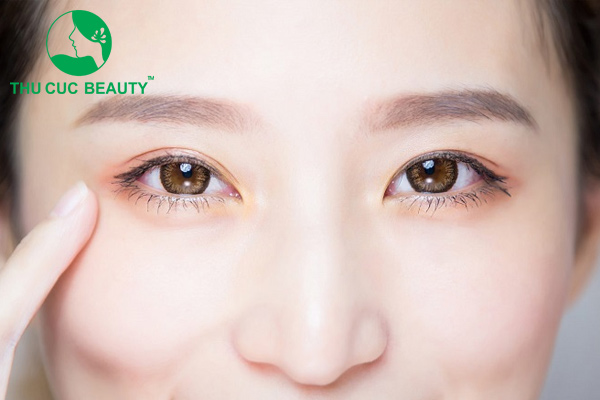 Làm đầy vùng mắt dưới bằng cấy mỡ tự thân.