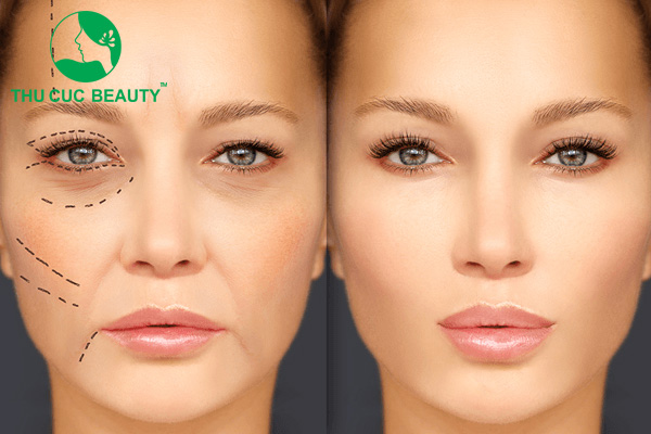 Cấy mỡ tự thân lên mặt là gì? Những điều cần lưu ý 2 cay mo tu than an toan