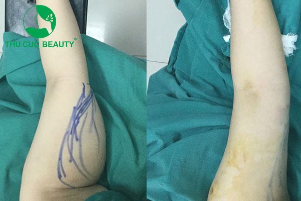 Hút mỡ bắp tay bằng công nghệ hiện đại Vaser Lipo.