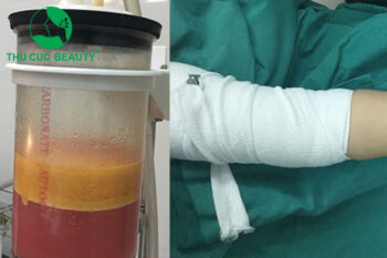 Cảnh báo biến chứng hút mỡ bắp tay giá rẻ