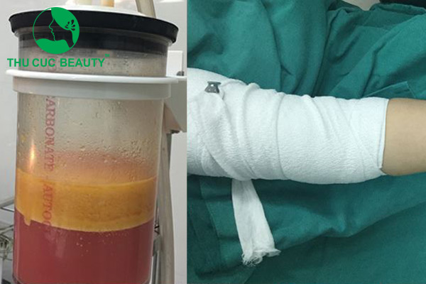 Cảnh báo hút mỡ bắp tay giá rẻ.