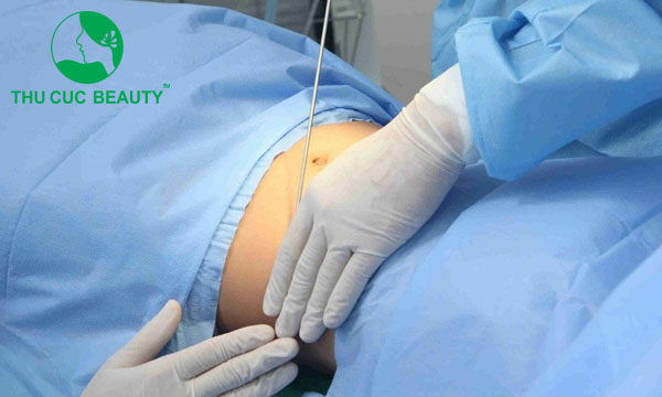 Hút mỡ bụng giúp giảm mỡ bụng nhanh chóng.