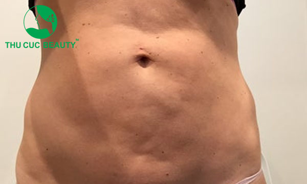 Tình trạng hút mỡ bụng bị lồi lõm gây mất thẩm mỹ.