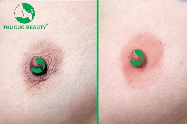 Nhũ hoa thâm khắc phục như thế nào để hồng hào? 4 Trị thâm nhũ hoa hiệu quả, nhanh chóng.