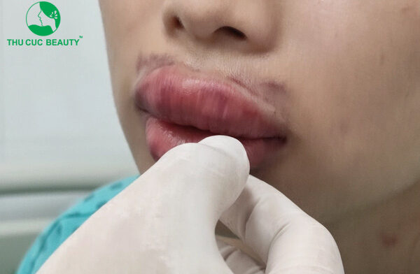 Tiêm tan filler có an toàn không? Khi nào cần tiêm tan filler? 2 Tiêm tan filler chỉ có tác dụng với filler có thành phần chủ yếu là HA.