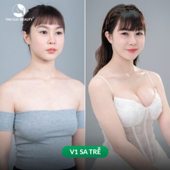 Lợi ích của treo ngực sa trễ mà nhiều người chưa biết