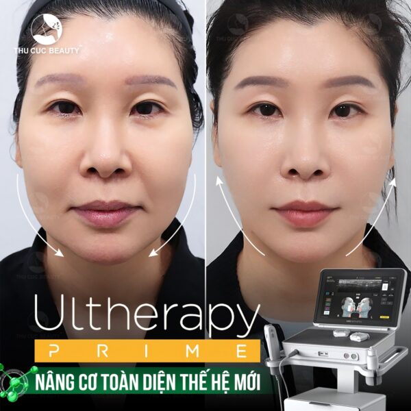 nang co ultherapy e1773138979804