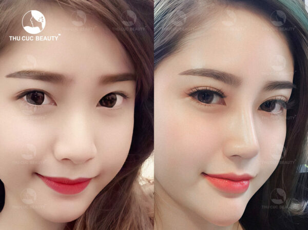 Nâng mũi sụn tai có vĩnh viễn không? Có nên nâng mũi sụn tai? 3 nang mui sun tai e1760352307252