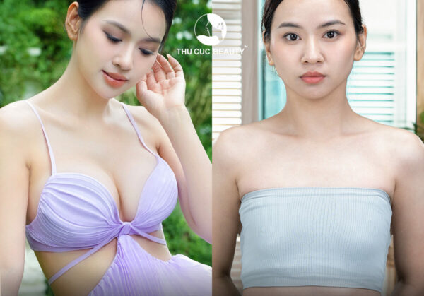 Đặt túi ngực nâng cấp vòng 1 và những lưu ý không nên bỏ qua 2 Những điều cần biết khi đặt túi độn.