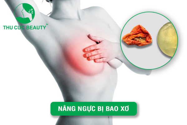 Nâng ngực bị bao xơ có nguy hiểm không? 1 Nâng ngực bị bao xơ