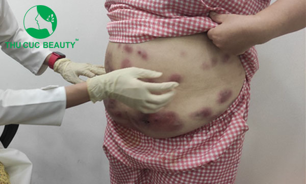 Hút mỡ bụng bị nhiễm trùng do thực hiện tại cơ sở không uy tín.