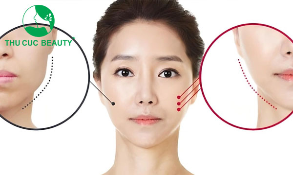 Tiêm botox gọn hàm mà mặt không nhỏ.