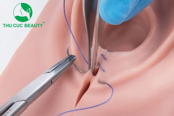 Phẫu thuật tầng sinh môn bao nhiêu tiền? 2 Phẫu thuật tầng sinh môn