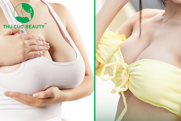 Thu nhỏ ngực phì đại