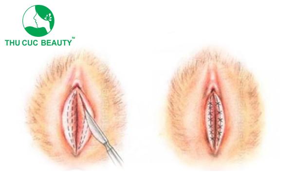 Cắt môi bé bao nhiêu tiền? Cắt môi bé ở đâu an toàn? 1 Cắt môi bé bao nhiêu tiền?