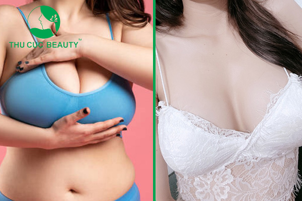 Thu nhỏ ngực phì đại