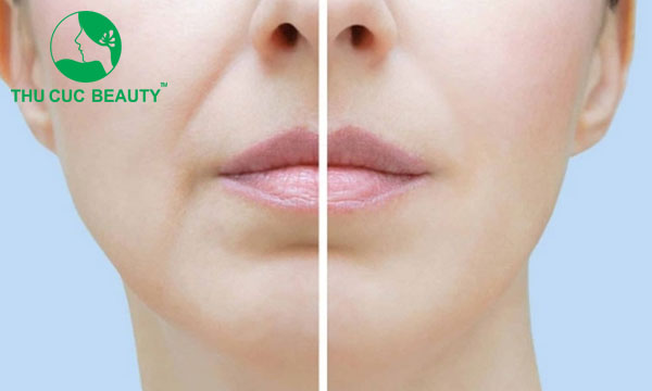 Tiêm filler rãnh cười có hiệu quả không?