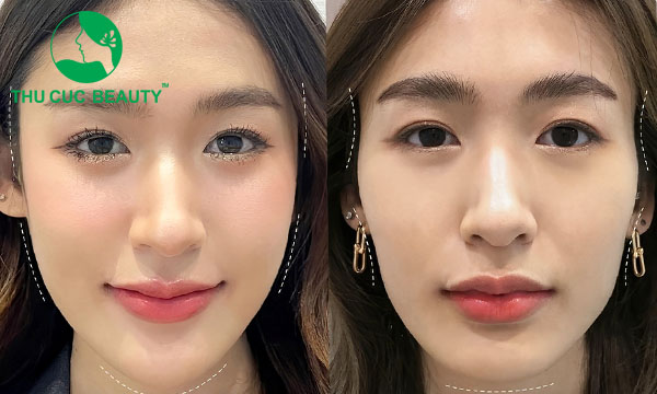 Tiêm filler và tiêm botox có thể thực hiện cùng lúc để đem lại vẻ đẹp toàn diện.