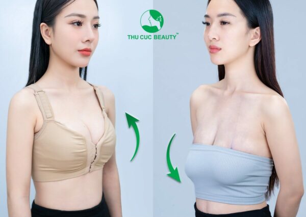 Treo sa trễ ngực được bao lâu? Có được vĩnh viễn không?