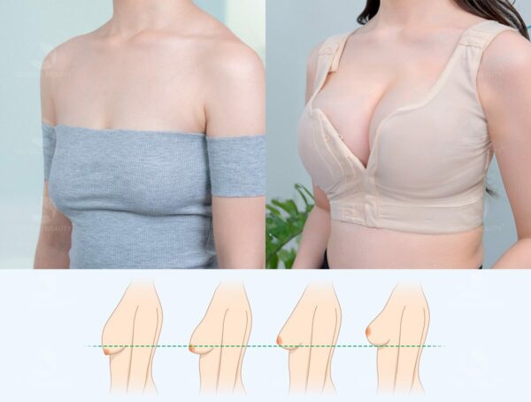 Treo ngực sa trễ mặc áo định hình bao lâu?