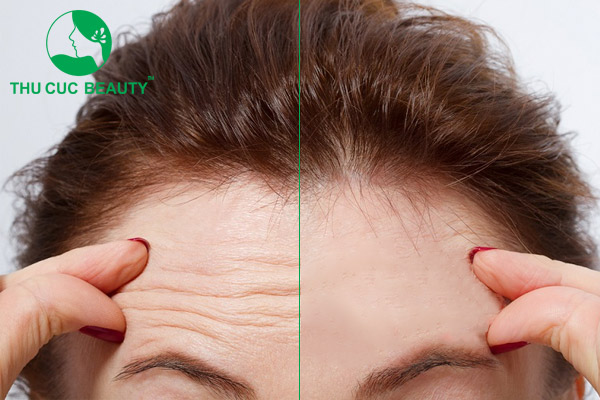 Xóa nhăn trán bằng botox bao nhiêu tiền? 1 Tiêm botox xóa nhăn trán
