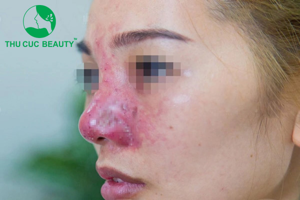 Nâng mũi bị co rút: Nguyên nhân và cách khắc phục 2 Nguyên nhân nâng mũi bị co rút