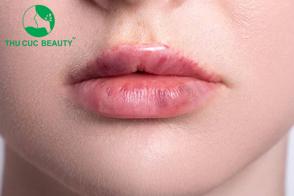 Biến chứng tiêm filler môi.