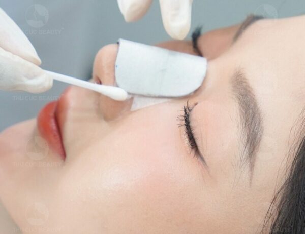 Nâng mũi bao lâu thì tháo nẹp? Cần lưu ý những gì sau khi tháo?