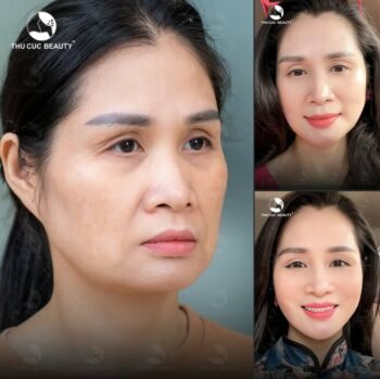 Căng da mặt không phẫu thuật – Xu hướng trẻ hóa da hiện đại