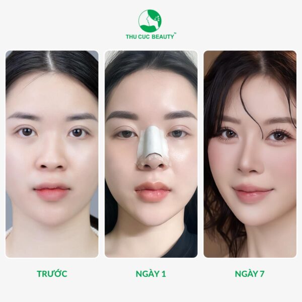 Nâng mũi bao lâu thì tháo nẹp? Cần lưu ý những gì sau khi tháo? 1 Nâng mũi bao lâu thì tháo nẹp?