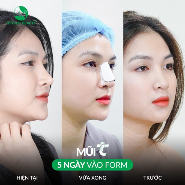 Nâng mũi bao lâu thì tháo nẹp? Cần lưu ý những gì sau khi tháo? 2 Nâng mũi bao lâu thì tháo nẹp?