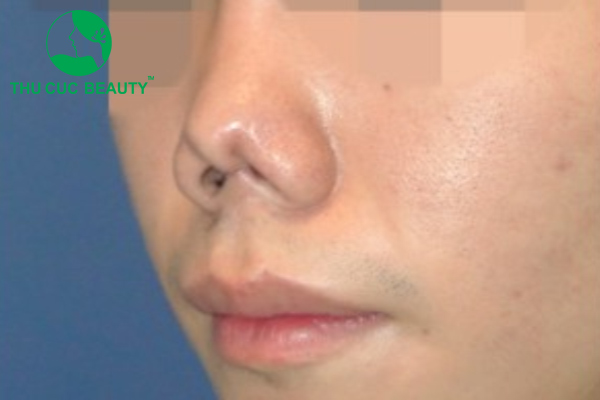 Nâng mũi bị co rút: Nguyên nhân và cách khắc phục 1 Dấu hiệu nâng mũi bị co rút