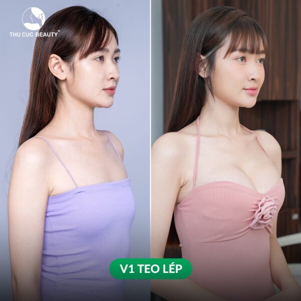 Cảnh báo nâng ngực bằng tiêm filler 3 Phẫu thuật nâng ngực và cấy mỡ tự thân là phương pháp cải thiện vòng 1 hiệu quả, an toàn.