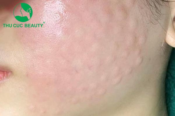 Tiêm meso có tác dụng gì? 3 Tiêm meso giúp se khít lỗ chân lông.