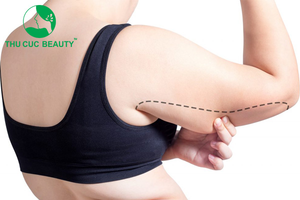 Tại sao mỡ bắp tay khó giảm? Hút mỡ bắp tay có hiệu quả không?