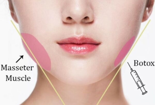 Tiêm botox gọn hàm nhiều lần có sao không? 1 Tiêm botox gọn hàm nhiều lần có sao không?