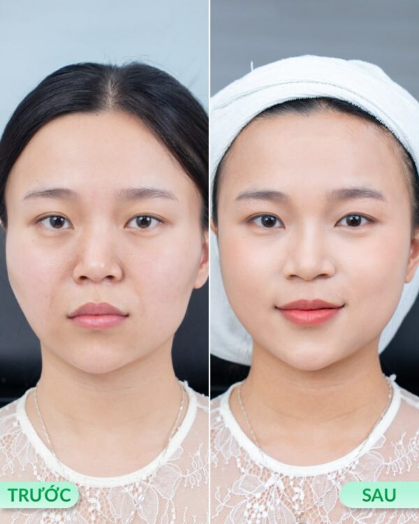 Tiêm filler bao nhiêu phụ thuộc vào nhiều yếu tố.