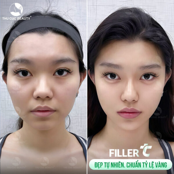 tiem filler gia bao nhieu tien e1763548907741