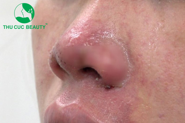 Tiêm filler mũi bị tràn có nguy hiểm không? 2 Tiêm filler mũi bị tràn là một trong những biến chứng thường gặp.