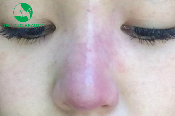 Tiêm filler mũi bị tràn có nguy hiểm không? 3 Dấu hiệu tiêm filler mũi bị tràn.