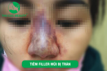 Tiêm filler mũi bị tràn có nguy hiểm không? 