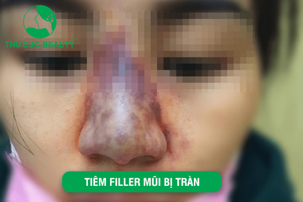 Tiêm filler mũi bị tràn có nguy hiểm không? 1 Tiêm filler mũi bị tràn