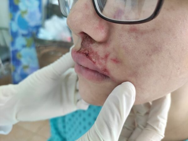 Biến chứng tiêm filler rãnh cười bị nhiễm trùng, hoại tử.