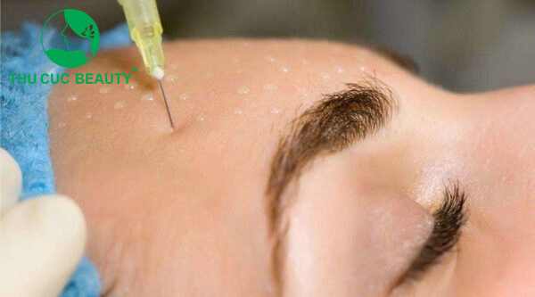 Tiêm meso có tác dụng gì? 1 tiem meso co tac dung gi e1764056354427