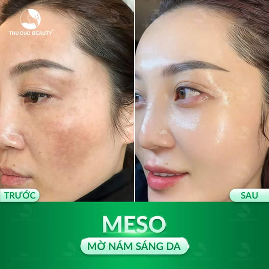 Tiêm meso có tác dụng gì?