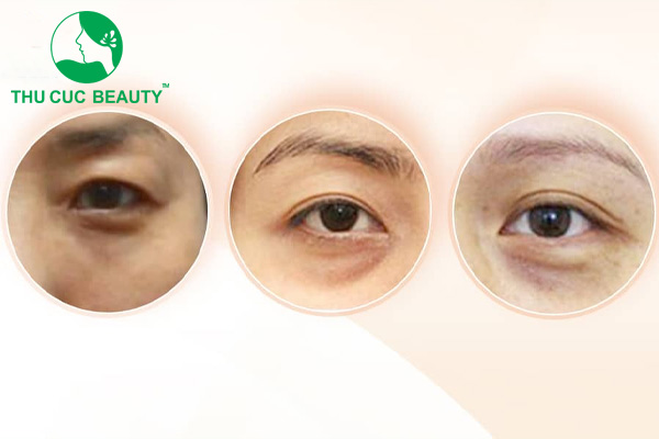 Làm đầy rãnh lệ bao nhiêu tiền?