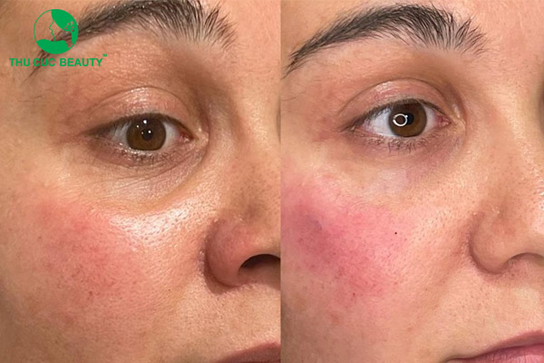 Làm đầy rãnh lệ bao nhiêu tiền? 1 Phẫu thuật xóa rãnh lệ bao nhiêu tiền?