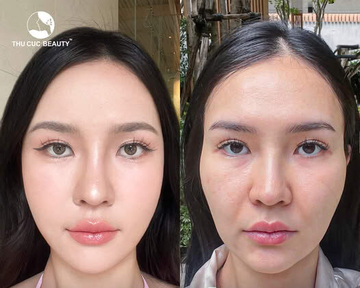 Tiêm filler thái dương có an toàn không?